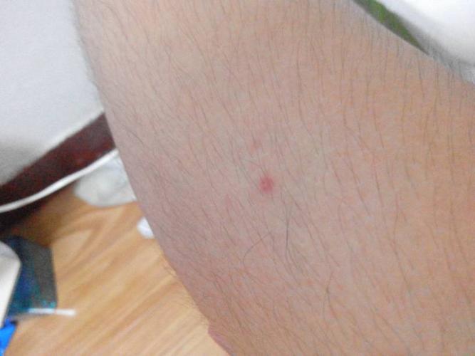 答: 感染艾滋病毒后约一周左右会出现皮疹,发热,淋巴结肿大等急性症状