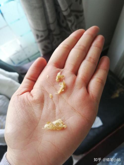 耳屎最大能有多大?