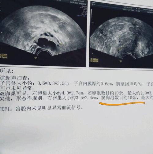 afc是 窦卵泡计数的缩写,是指利用b超彩超等等对卵巢的卵泡数目,大小