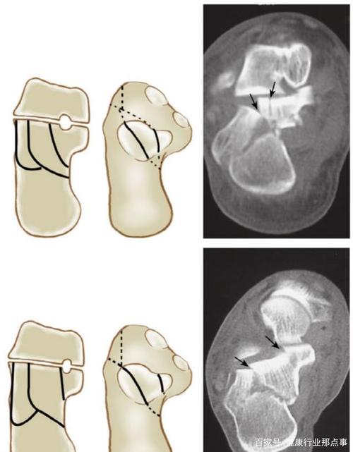 多图详解5种常见跟骨骨折分型