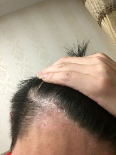 今年30了,因念书染发和冷水洗头过敏头皮多,想刮了头抹皮炎平,能长