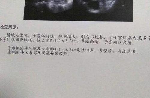 唠唠子宫肌瘤巧克力囊肿让人心塞的那段日子