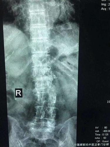 患儿董xⅩ,女,77岁,胸12,腰1椎体压缩性距骨骨折,腰椎骨质增生.