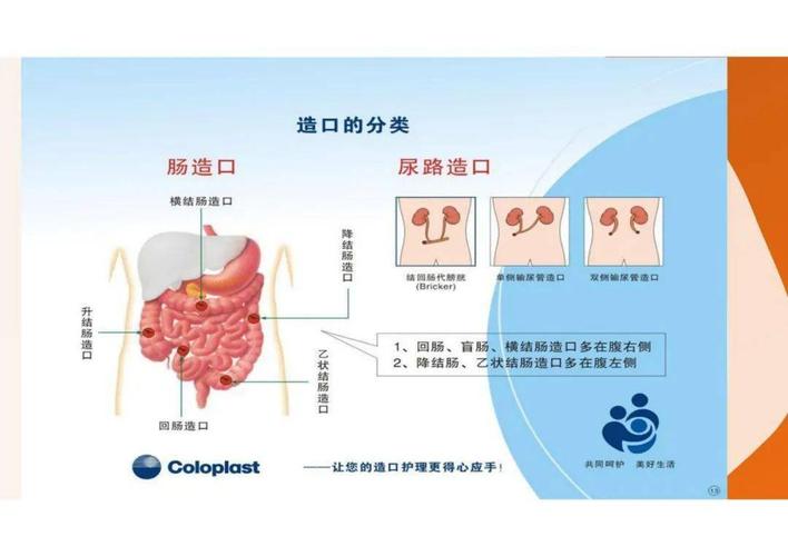 【ppt】肠造口术后的护理