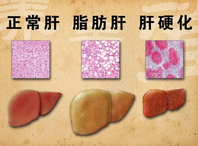 都是脂肪肝,为什么有的没事,有的成了癌?只有胖人会得