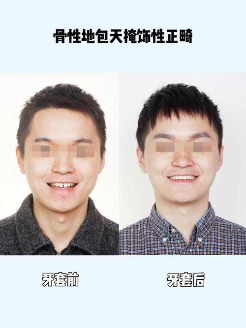 7315牙套日记166166骨性地包天掩饰性正畸_正畸_牙套_磨牙