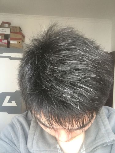 青少年白发是怎么回事?