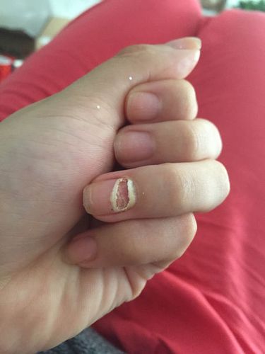 请问我手指甲头突然变白然后一大截越长越白,里面空了,我就把它扯了