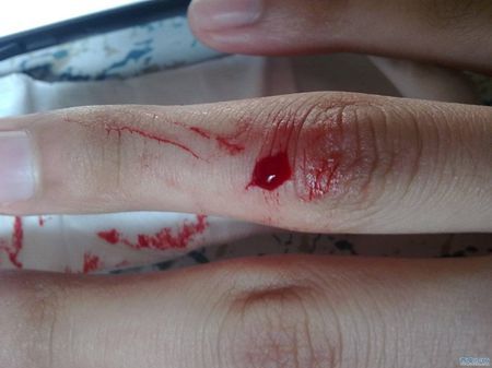 手出血的相片