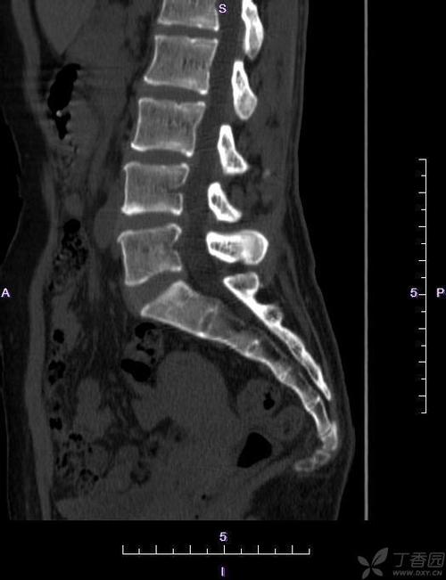 【读片】骶尾椎ct [病例帖]