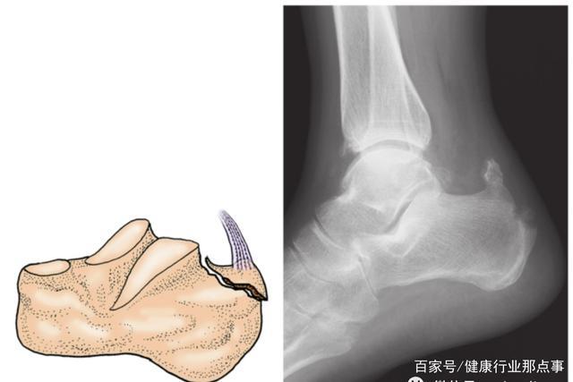 多图详解5种常见跟骨骨折分型