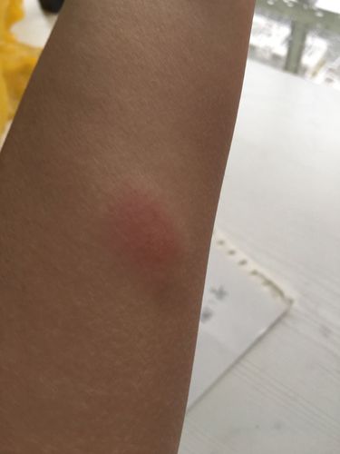 结核皮试每天变化图片我前天做的结核皮试过了两天变成这样了 是不是
