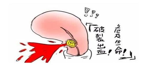 瘢痕妊娠风险大,及时就诊"保宫"又"保命"