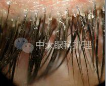 卫生社团眼睛瘙痒不适眼干眼红眼屎变多小心可能是睫毛感染了螨虫