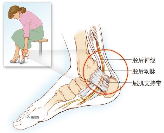 疼痛解剖学|后跗管综合征