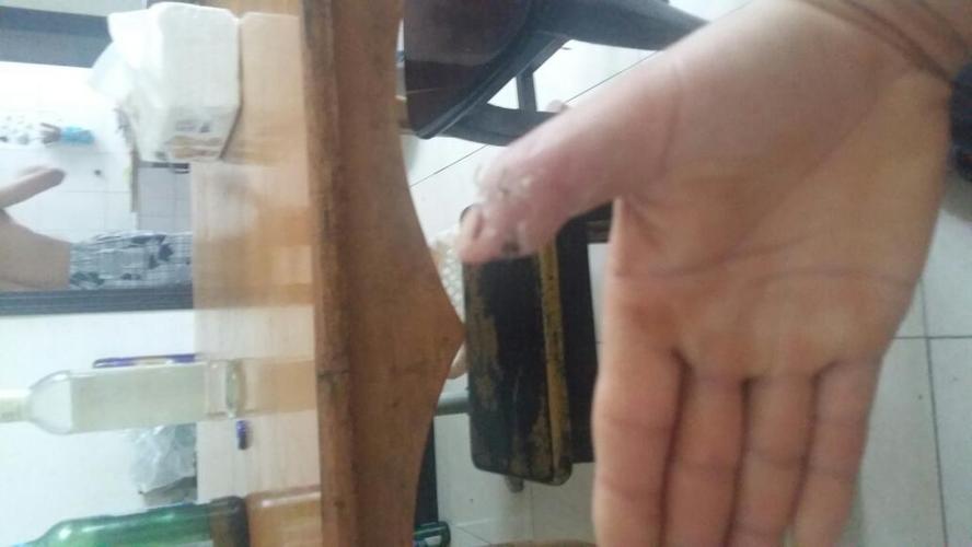 右手拇指怎样才能确定为九十级伤残