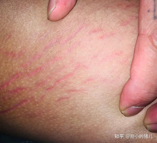 我今天发现我大腿内侧有一条一条的红色条纹这是怎么了