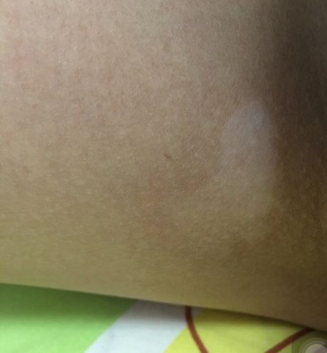 腿内侧有白斑,是白癜风吗