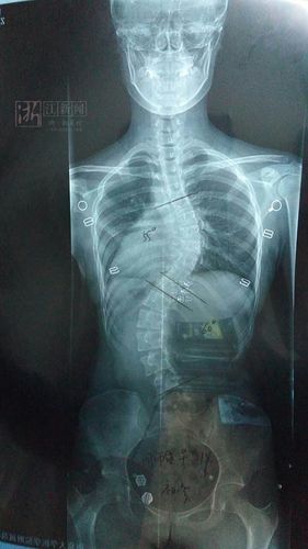 x光片下,周雨露的脊椎呈s形.