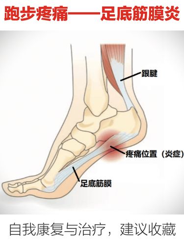 【建议收藏】跑步伤痛|足底筋膜炎