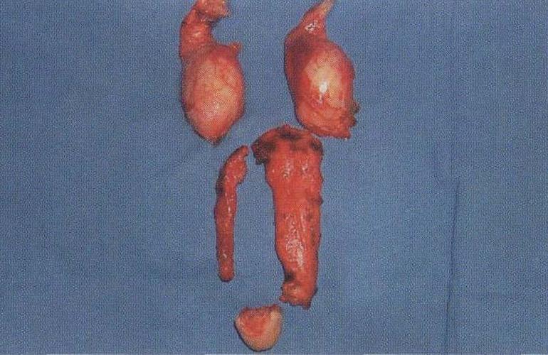 图6-5-3-1-7 切除的组织(睾丸,阴茎海绵体,部分尿道海绵体和部分龟头)