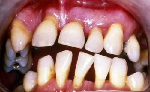 比智齿,龋齿还可怕的,是牙龈萎缩!