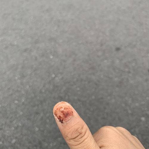 自己左脚把自己右手踩了 还穿着钉鞋 指甲踩了个洞 去医院 医生给我拔