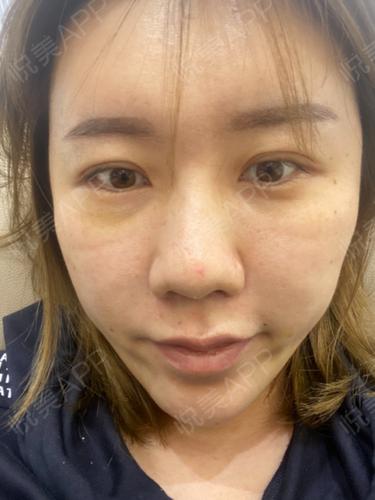 做完脂肪填充后,苹果肌那块还是有个沟是没有填上么