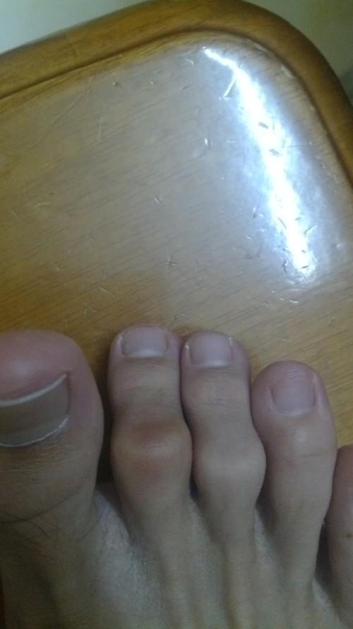 脚趾关节处痛按下去会痛脚趾自己弯曲是也会痛是怎么回事啊是关节受伤