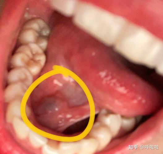 舌下腺囊肿的自愈