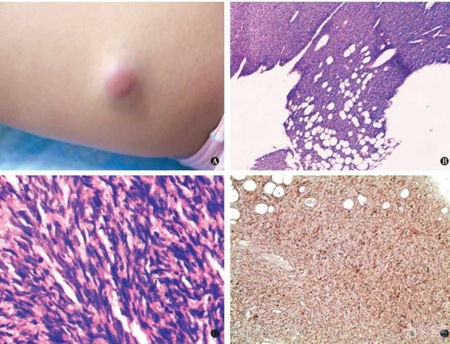 隆凸性皮肤纤维肉瘤1例