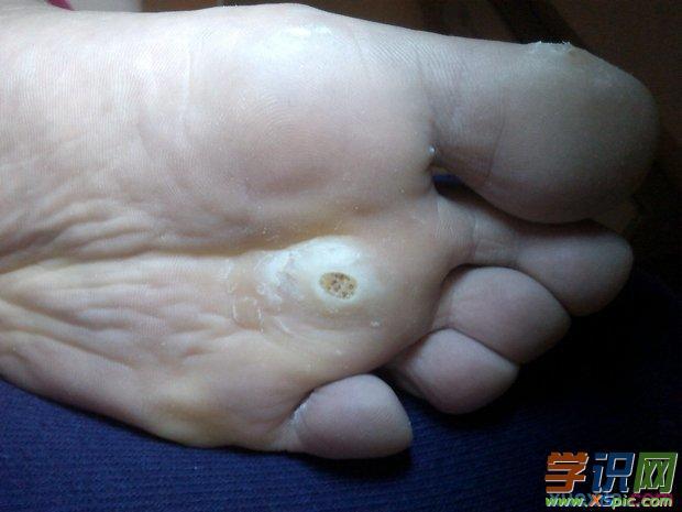 血泡刺是怎么形成的
