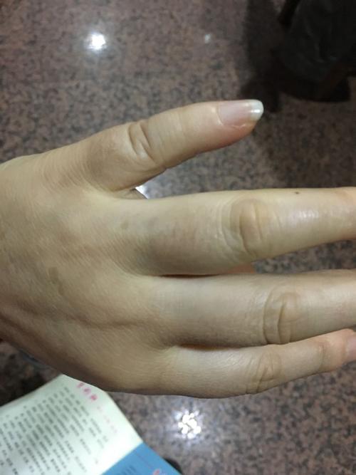左手无名指突然肿了,非常疼,我妈说是以前手指里面感觉有个痘痘之类的