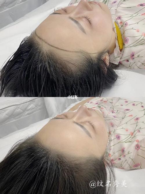 纹发际线前后对比北京纹名秀美_发际线_三里屯_装修_修饰脸型_北京纹