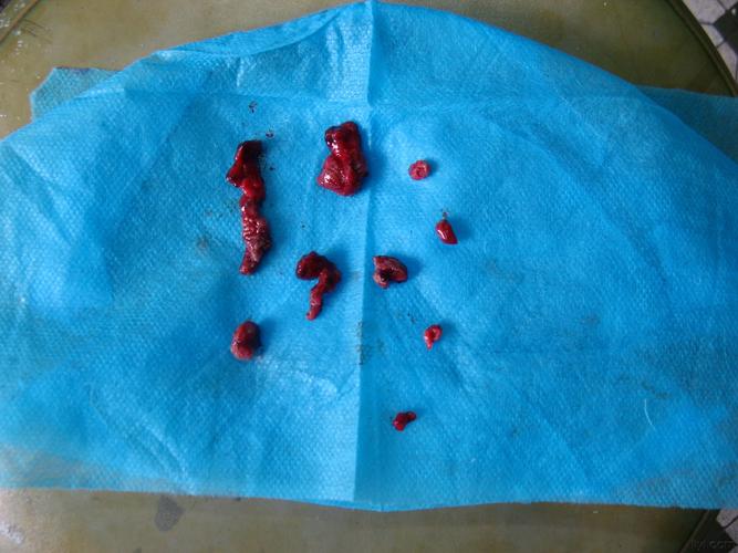 状混合痔嵌顿手术一例