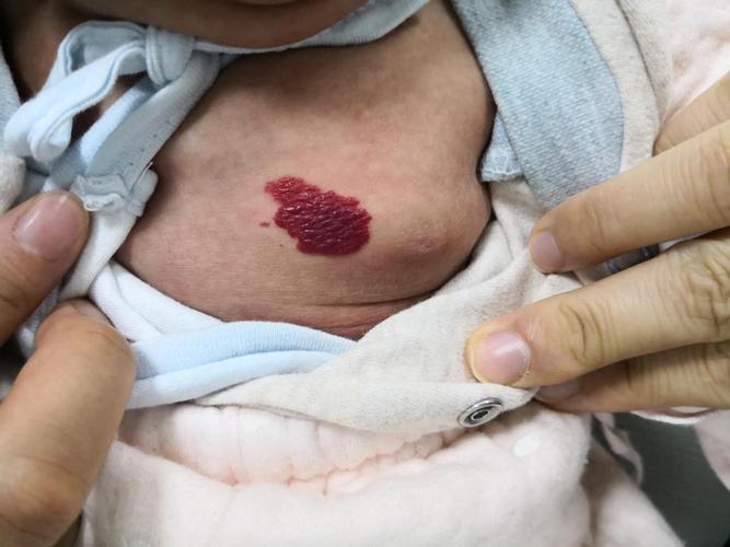 关于乳腺区血管瘤的几点忠告