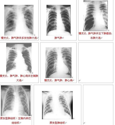 简单教你如何看胸片及胸片经典胸片图谱