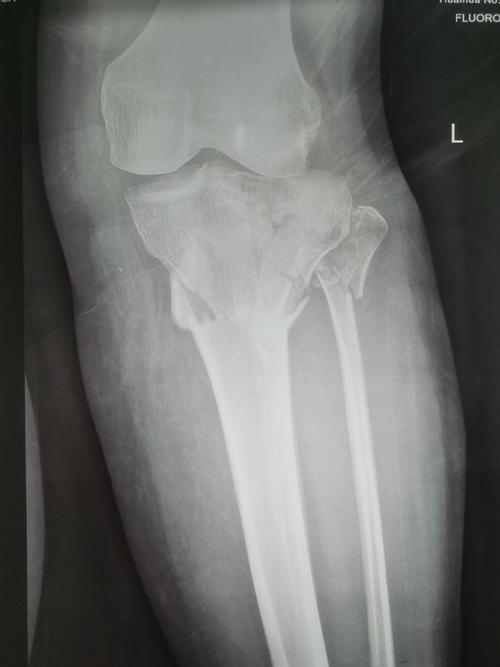 急查dr示:左胫腓骨上段粉碎性骨折,入院后完善ct及mri检查,诊断为:1.