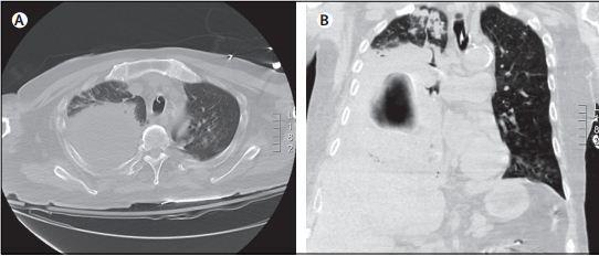 巴斯德菌感染性脓胸致死一例