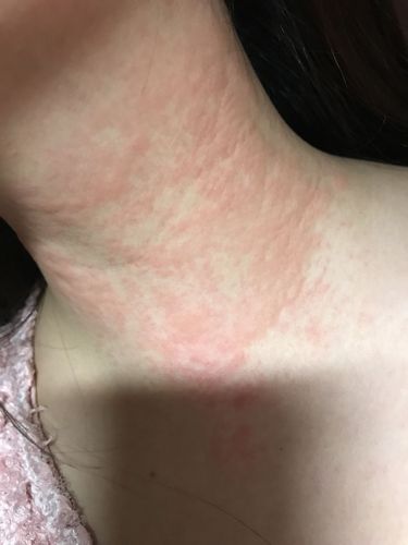 请问脖子上这个是皮炎还是湿疹啊?只有脖子上有,突然起来的,痒痒