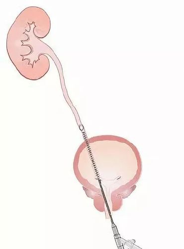 对于膀胱结石,输尿管中下段结石可以采取经尿道腔镜碎石取石术.