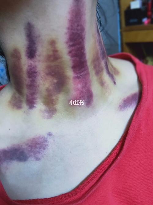 中医揪痧治疗_颈椎病_深圳自由行热门攻略_感冒咳嗽_痛经_美容院_汗蒸