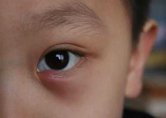 "针眼"是睑腺炎的俗称,又称"麦粒肿",是由眼睑的睑板腺或毛囊及其