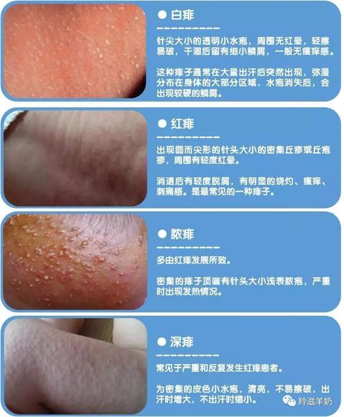 宝妈最容易误判的皮肤红疹!小心越护理越严重!