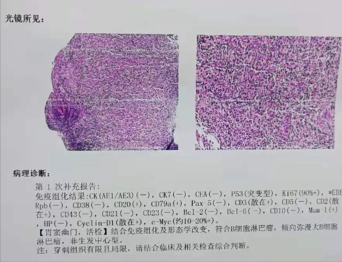 伪装成胃溃疡的胃恶性淋巴瘤究竟是怎么回事?专家带你了解下