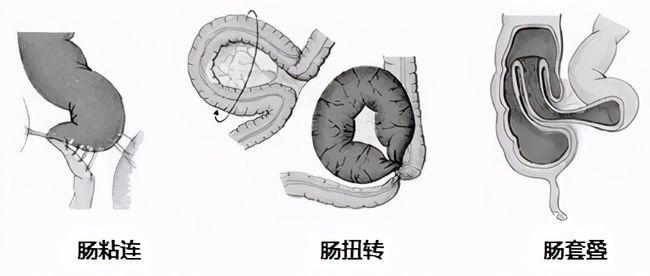 腹部阵发性绞痛,警惕肠梗阻!|结肠|肿瘤|肠管|绞窄性_网易订阅