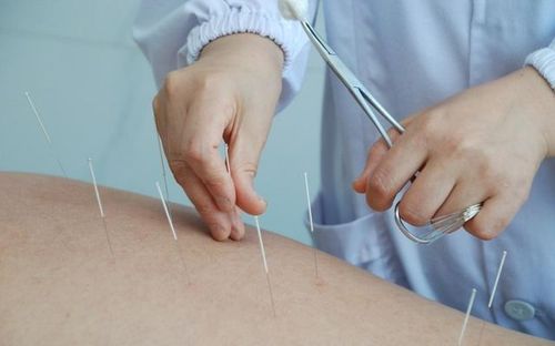 针灸有什么作用针灸可以随便扎吗这几个注意事项一定要知道
