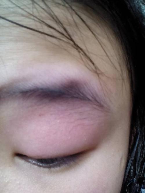 昨天眼睛很痛,甚至于眼球.