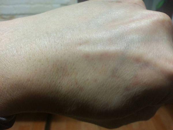 手脚有小红点手的背面脚的侧面一年多