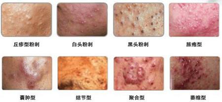痘痘和粉刺如何治疗最好